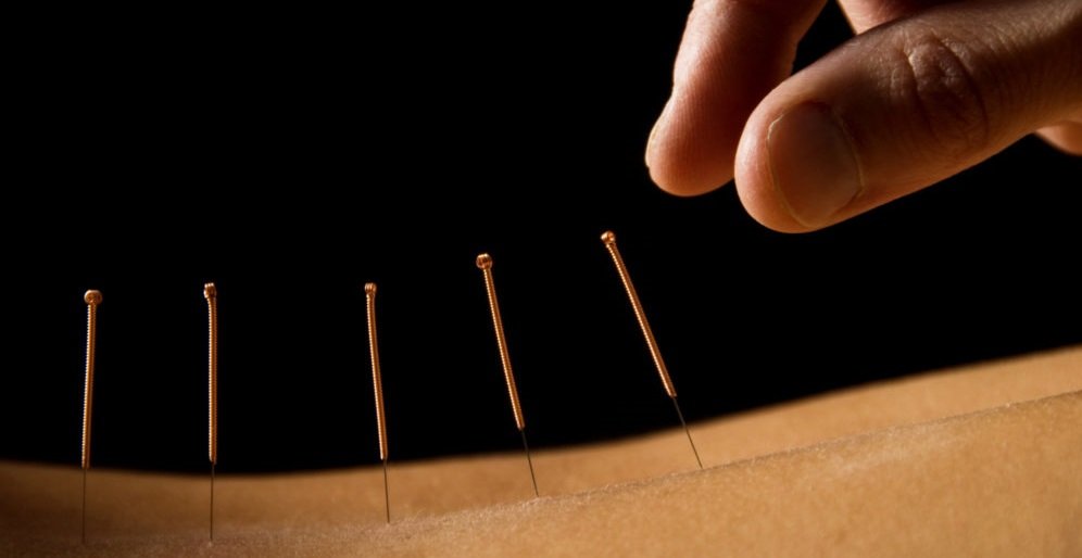 acupuncture needles on back needles on the curve of the back