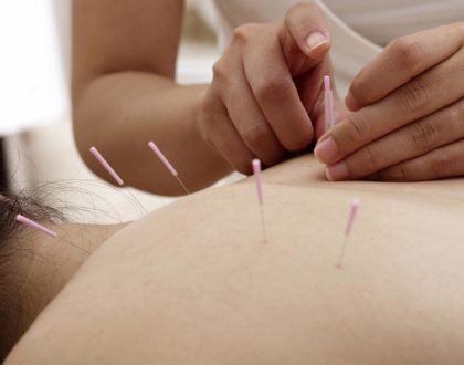 Acupuncture DuPont Circle dc-needles on the back