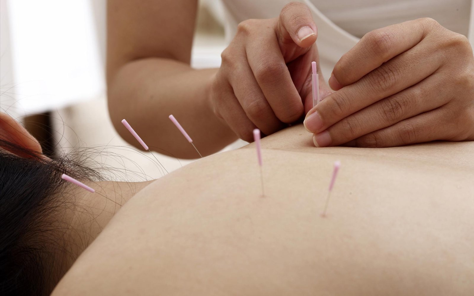 Acupuncture DuPont Circle dc-needles on the back