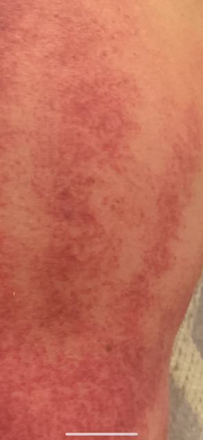 blood stagnation evidenced by cupping of upper right shoulder